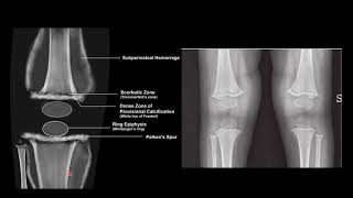 SCURVY VS RICKETS RADIOLOGY [upl. by Lemmor979]