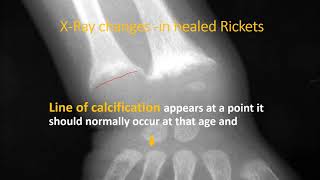 XRay wrist in rickets Part 23  Rickets  Pediatrics [upl. by Nosittam794]