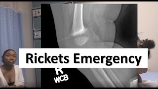 Rickets in the Pediatric Emergency Department [upl. by Nivloc778]