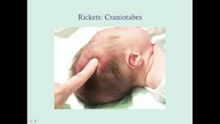 Rickets  CRASH Medical Review Series [upl. by Eimar]