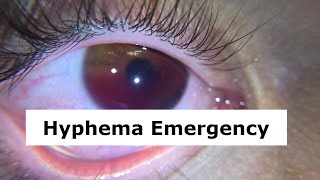 Hyphema Emergency [upl. by Campbell254]